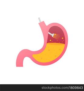 Stomach endoscopy. Endoscope in stomach through esophagus. Vector stock illustration. Stomach endoscopy. Endoscope in stomach through esophagus. Vector stock illustration.