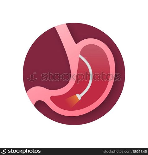 Stomach endoscopy. Endoscope in stomach through esophagus. Vector stock illustration. Stomach endoscopy. Endoscope in stomach through esophagus. Vector stock illustration.
