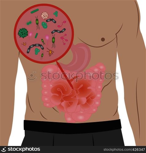 Stop infection overgrowth in intestine vector illustration . Gastrointestinal digestive disorder