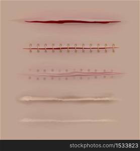 Surgical sutures healing stages. Realistic bloody wound and stitch closeup texture. Scars, stitched gash different curing steps, medicine vector isolated set. Surgical sutures healing stages. Realistic bloody wound and stitch. Scars, stitched gash different curing steps, medicine vector set