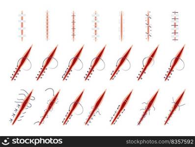 Suture icons set cartoon vector. Wound surgical. Doctor laceration. Suture icons set cartoon vector. Wound surgical