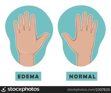 Swollen hand and normal hand. Edema and lymphedema. Vector illustration of the disease before-after. Swollen hand and normal hand. Edema and lymphedema. Vector illustration of the disease before-after.