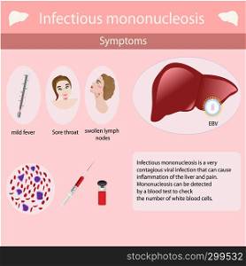 Symptoms of Infectious mononucleosis. Vector illustration infographics