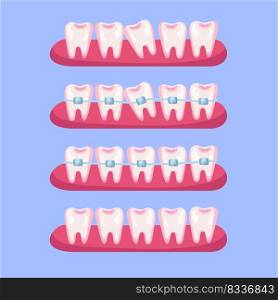 Teeth before and after braces cartoon illustration set. Stages of dental alignment or treatment with usage of brackets for beautiful smile. Orthodontist, healthcare, medicine concept