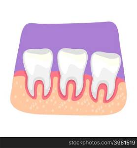 Teeth inflammation 2D vector isolated illustration. Inflamed gums flat sticker on cartoon background. Bacterial infection. Gingivitis risk colourful scene for mobile, website, presentation. Teeth inflammation 2D vector isolated illustration