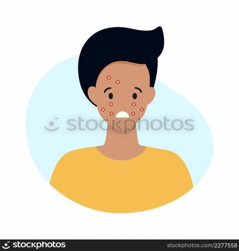 The face of a man with acne on his face. Skin diseases and allergic reactions. Vector illustration for the dermatology clinic.