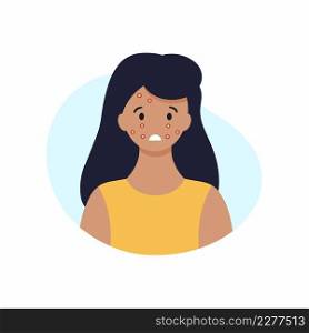 The woman suffers from a problem with the skin of the face and acne. Vector illustration on the topic of cosmetology and dermatology. Health and medicine. Skin care.