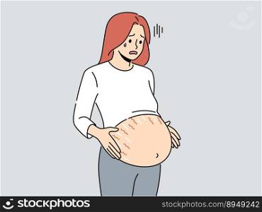 Tired pregnant woman with huge belly with stretch marks on last months of pregnancy. Exhausted unwell future mother awaiting childbirth. Vector illustration. . Pregnant woman with stretchmarks on belly 
