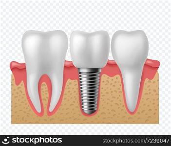 Tooth implant. Human teeth and dental implant, denture orthodontic technology. Artificial teeth dentistry implantation jaw. stomatology vector concept isolated o. Tooth implant. Human teeth and dental implant, denture orthodontic technology. Artificial teeth dentistry implantation jaw vector concept
