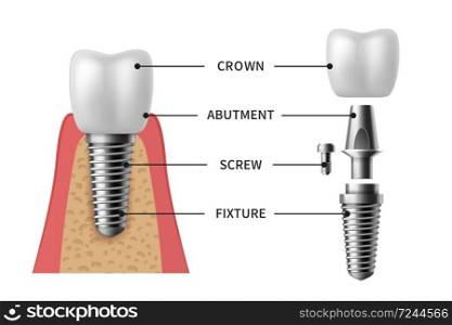 Tooth implant. Realistic implant structure pictorial models crown. Abutment, screw denture orthodontic implantation teeth. stomatology clinic concept vector set. Tooth implant. Realistic implant structure pictorial models crown. Abutment, screw denture orthodontic implantation teeth vector set