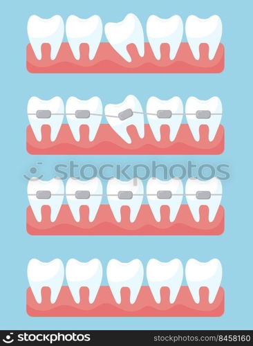 Tooth with orthodontic braces set. Illustrations of before and after treatment and correction with brackets on light blue background. Dental clinic and orthodontist services concep