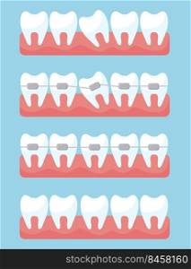 Tooth with orthodontic braces set. Illustrations of before and after treatment and correction with brackets on light blue background. Dental clinic and orthodontist services concep