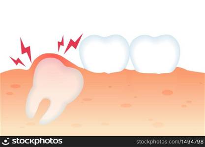 Toothache with Tooth Growth Flat Vector Realistic. Dental Pathology Tooth is not Cut from Gums. Physiological Discomfort and Heavy Load in Mouth. Orthodontic Complex to Solve Dental Problems.