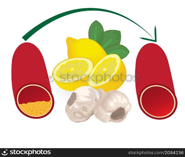 Turning high level of atherosclerotic plaque in blood vessel into normal level with healthy meal like lemon amd garlic medical vector infographics on a white background