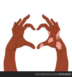 Two hands showing heart shape, one hand with vitiligo patch
