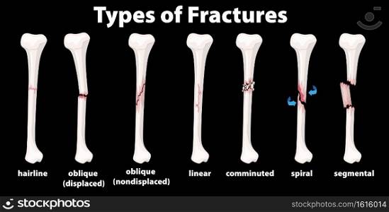 Type of Fractures diagram