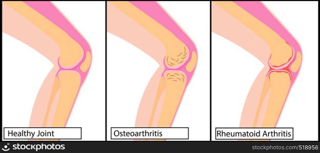 Types of arthritis Knee and a healthy knee vector illustration on a white background