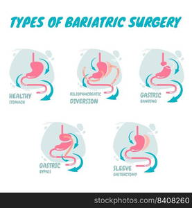 Types of bariatric surgery weight loss procedures- gastric bypass, sleeve gastrectomy, adjustable gastric band. Stomach reduction medical diagram infographic. Health care concept. Vector illustration.. Types of bariatric surgery, it is process for the digestive system in stomach, A new types of bariatric surgery