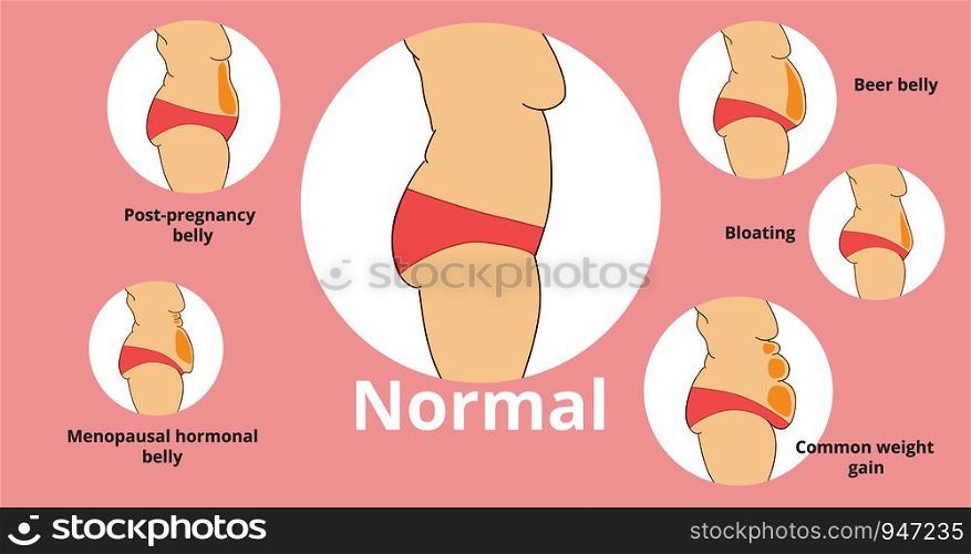 Types of female tummies banner. Tummy tuck surgery or abdominoplasty vector illustration. Post-pregnancy, menopausal hormonal belly, beer belly, bloating belly, common weight gain belly.. Types of female tummies banner