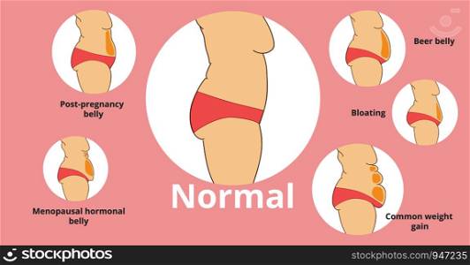 Types of female tummies banner. Tummy tuck surgery or abdominoplasty vector illustration. Post-pregnancy, menopausal hormonal belly, beer belly, bloating belly, common weight gain belly.. Types of female tummies banner