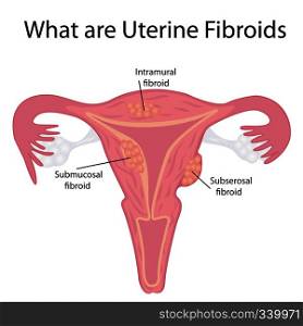 Types of Uterine Fibroids. Vector illustration on a white background isolated