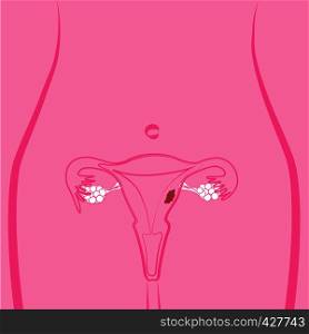 Uterine Fibroid vector illustration