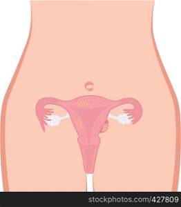 Uterine Fibroid vector illustration. Gynecology problem. Tumor in female reproductive organ