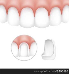 Vector dental veneers on human teeth isolated on white background. Dental veneers on human teeth