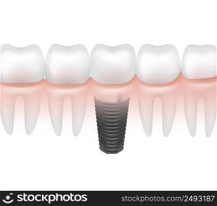 Vector metal dental implant between other teeth in gum side view isolated on white background. Metal tooth implant