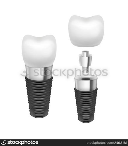 Vector metal disassembled tooth implant side view isolated on white background. Vector tooth implant