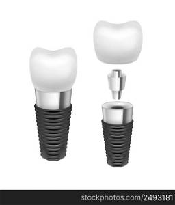 Vector metal disassembled tooth implant side view isolated on white background. Vector tooth implant