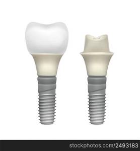 Vector plastic assembled tooth implant side view isolated on white background. Plastic assembled tooth implant