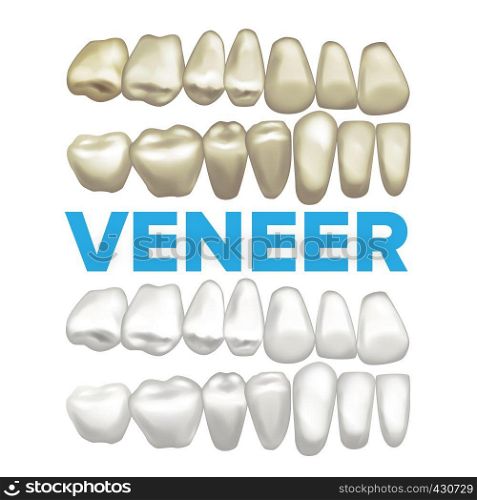 Veneer Vector. Dental Veneer Concept. Medical Banner Design Element. Tooth Before After. Illustration. Veneer Vector. Dental Veneer Concept. Medical Banner Design Element. Tooth Before And After. Illustration