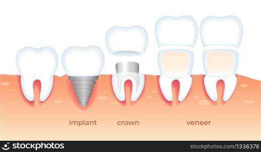 Visualization of Different Ways Orthodontic Restoration. Implant, Crown, Dental Veneer Isolated on White Background. Set of Teeth Problem. Diseased Tooth. Stomatology Aid Flat Vector Illustration.. Teeth Problems. Diseased Tooth in Gum. Stomatology