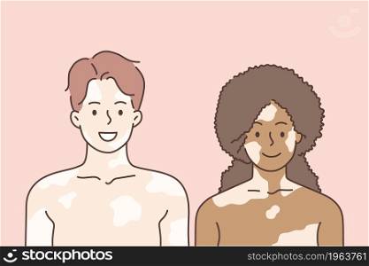 Vitiligo and mixed race love concept. Young smiling woman and man couple standing together having vitiligo on faces and bodies feeling love vector illustration . Vitiligo and mixed race love concept