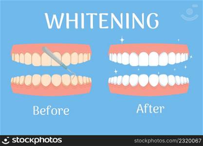 Whitening teeth before and after, stomatology, dental concept isolated. Healthcare and beauty stock. Vector illustration