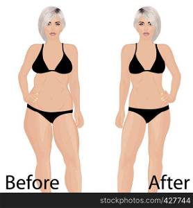 Woman body correction. Liposuction. Before and after. vector illustration on a white background isolated. Body shaping
