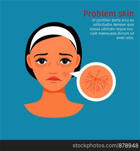Woman face problem skin with buried capillaries, vector illustration. Woman face problem, buried capillaries skin