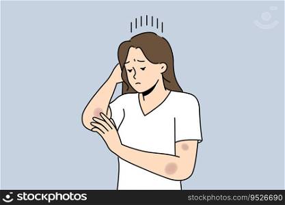 Woman with bruises on arms is sad and looks at abrasions received after fall or accident on road. Depressed girl needs healing ointment for bruises and wounds left due to domestic violence. Woman with bruises on arms is sad and looks at abrasions received after fall or accident on road